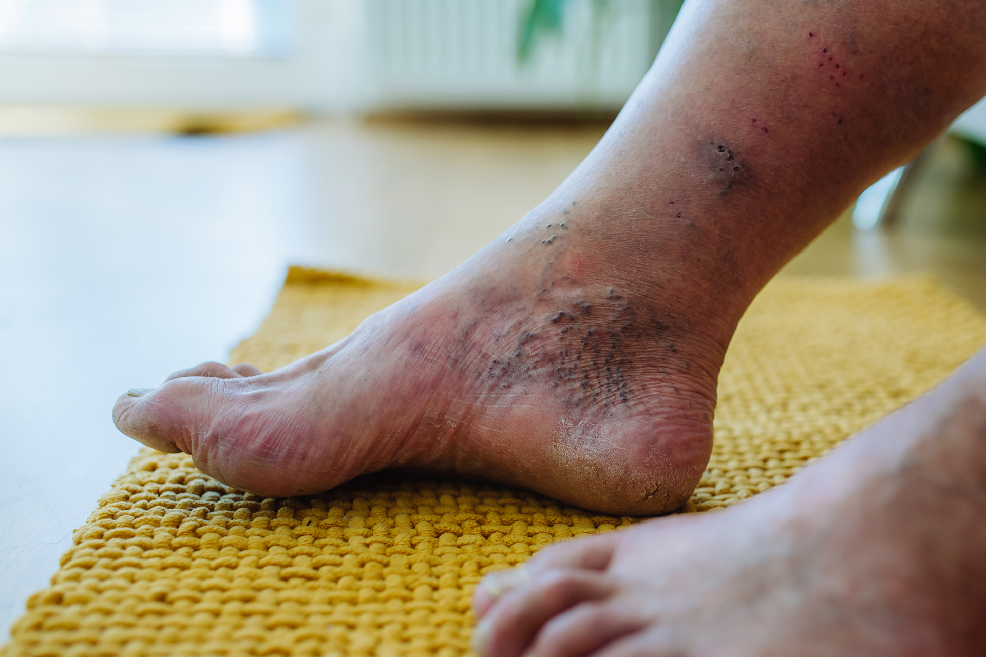 Comprehensive Diabetic Foot Ulcer Management Effective Care, Prevention, and Healing Strategies